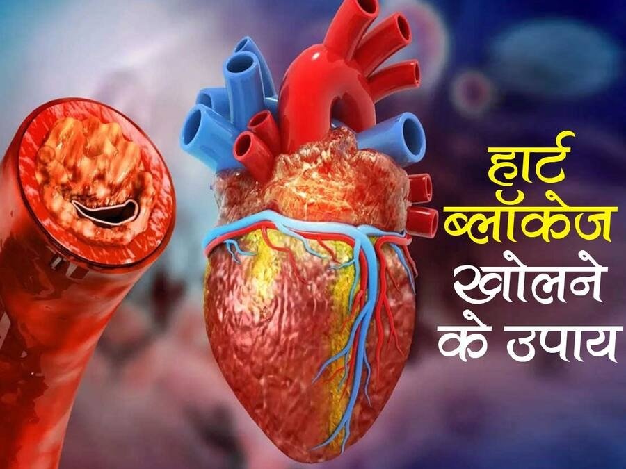 हार्ट ब्लॉकेज (Heart Blockage) खोलने के उपाय