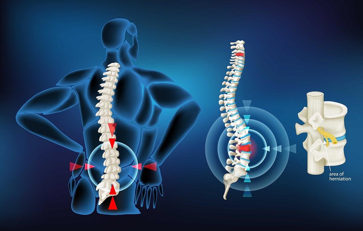 Sciatica Pain: कारण, लक्षण और उपचार