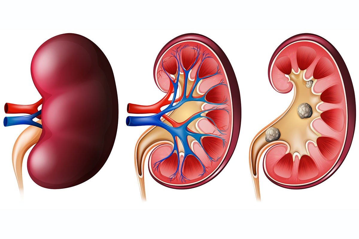 Kidney Stone : Symptoms, Cause And Treatment