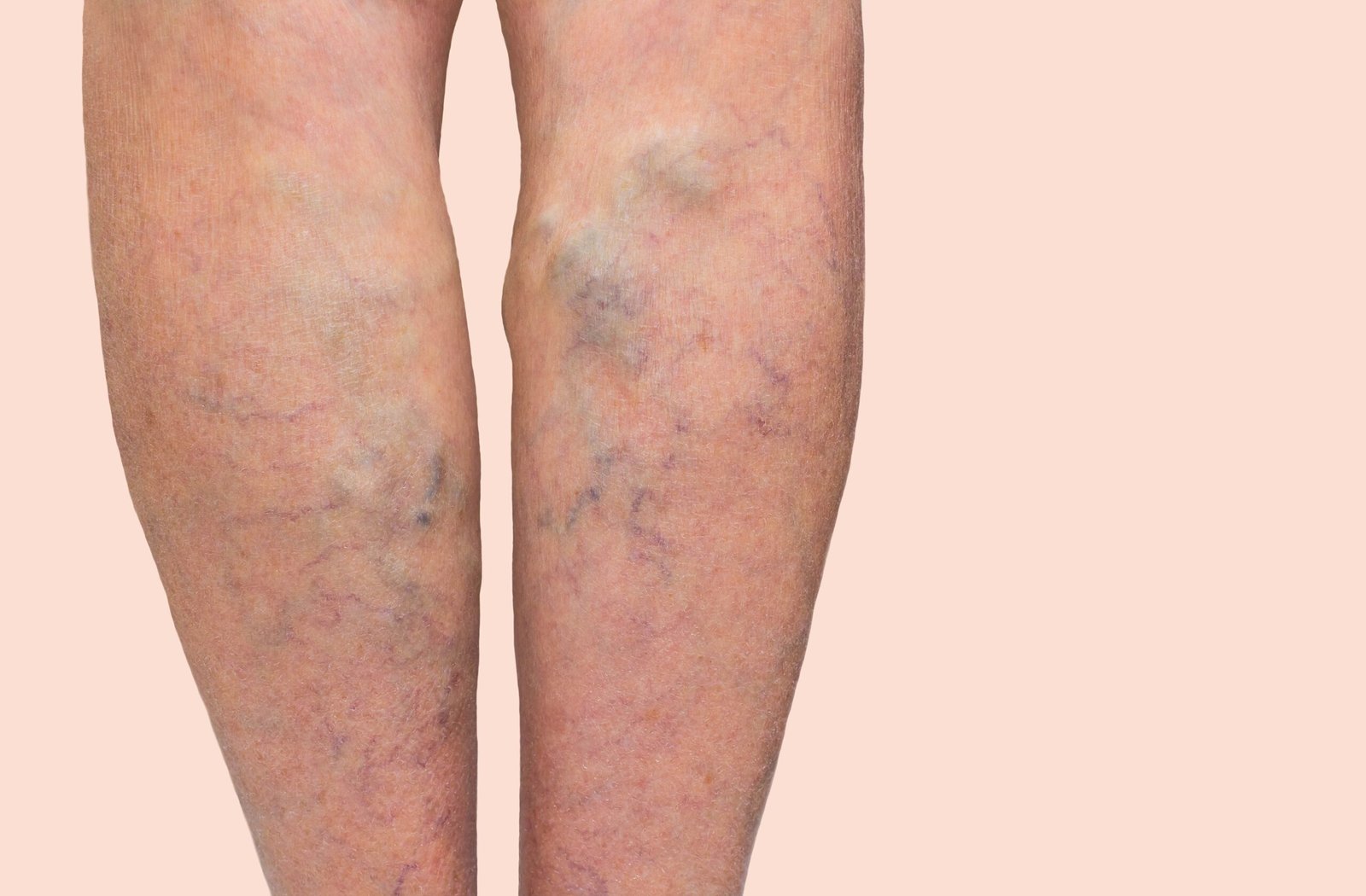 Varicose Veins: Causes, Symptoms & Ayurvedic Treatment