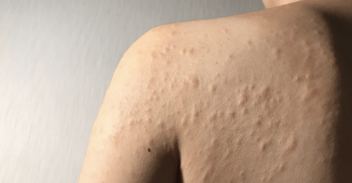 Urticaria and Other Skin Allergy | Allergy 