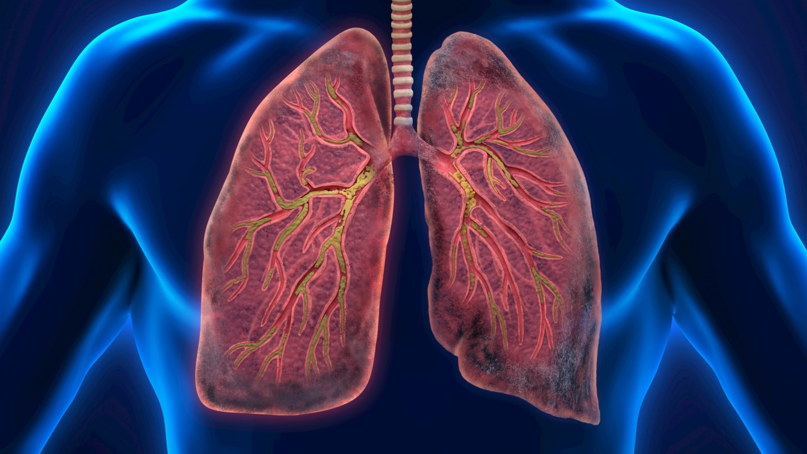 Best Ayurvedic Treatment for Bronchitis: Causes, Symptoms & Natural Relief