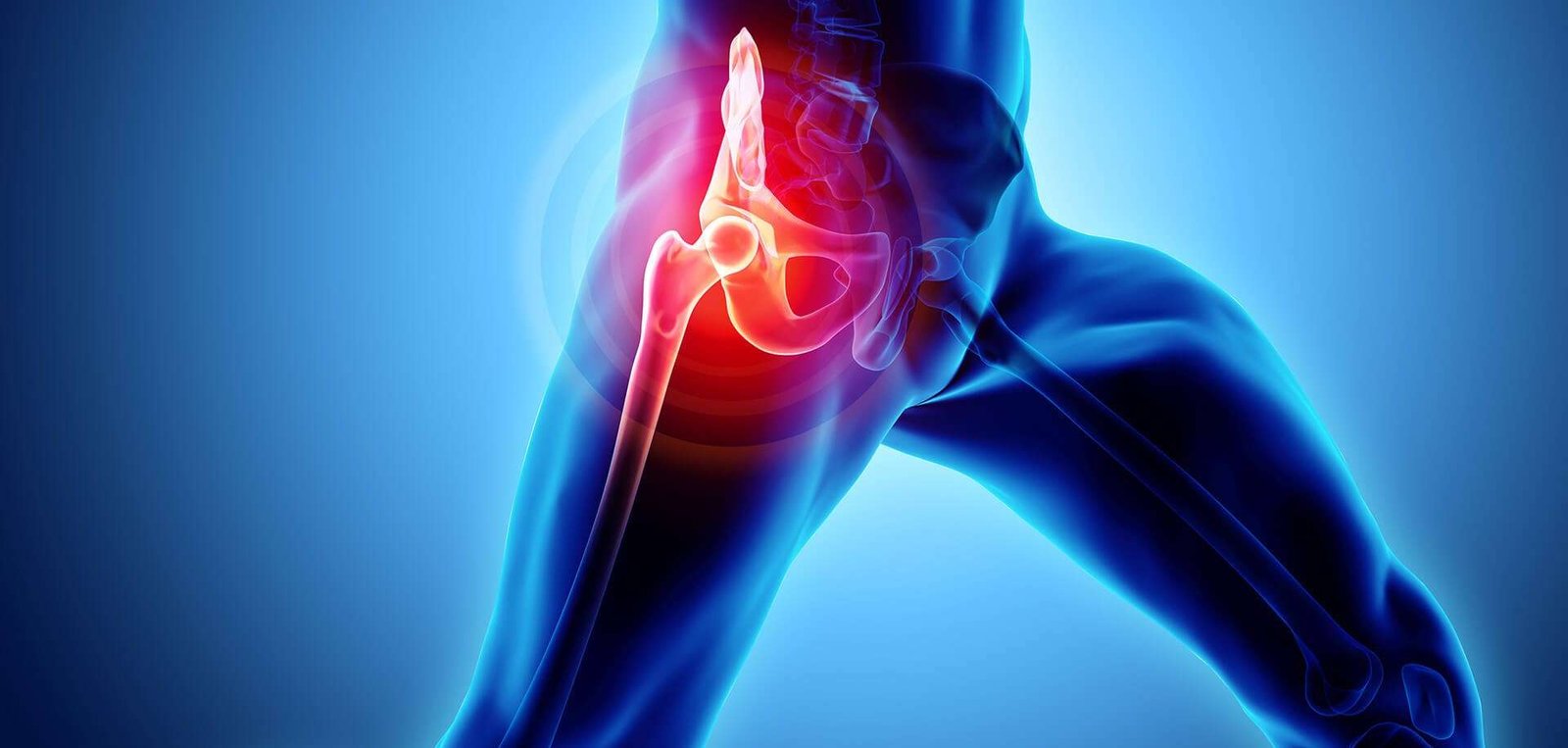 Best Ayurvedic Treatment of Avascular Necrosis (AVN)