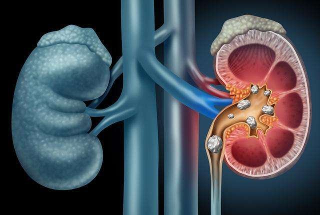 Best Ayurvedic Treatment for Kidney Stones: Causes, Symptoms, Remedies & Medicine