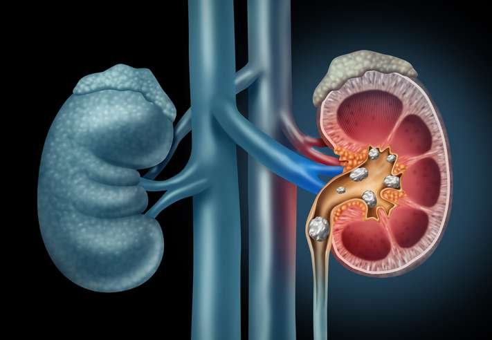 Natural Ayurvedic Ways to Dissolve Kidney Stones Without Surgery