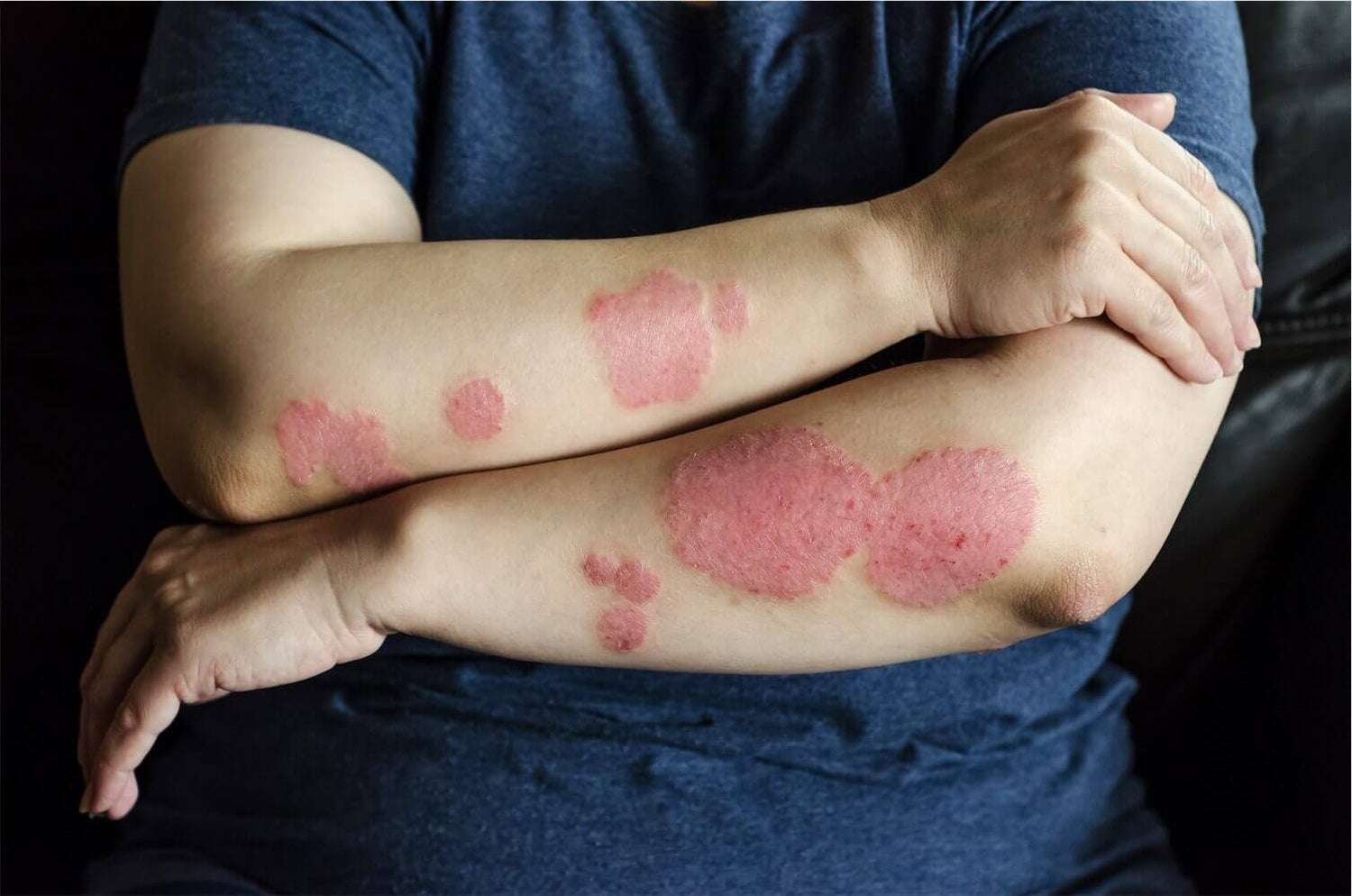 Best Ayurvedic Treatment for Psoriasis: Causes, Symptoms & Natural Remedies