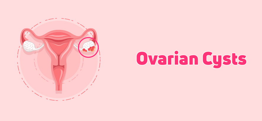 Best Ayurvedic Treatment for Ovarian Cyst – Causes, Symptoms & Natural Remedies