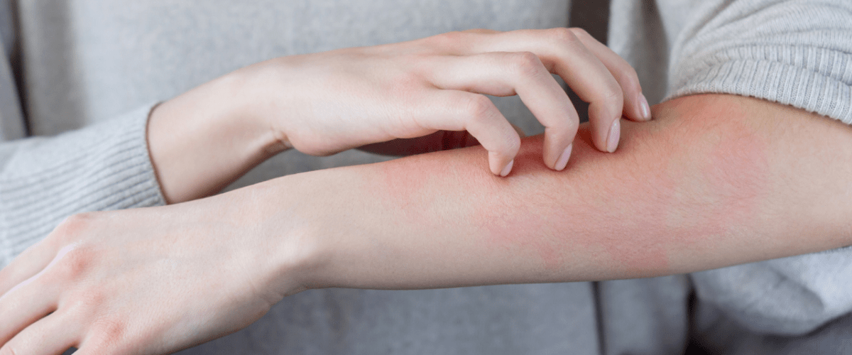 Best Ayurvedic Treatment for Skin Allergies – Eczema, Psoriasis, and More