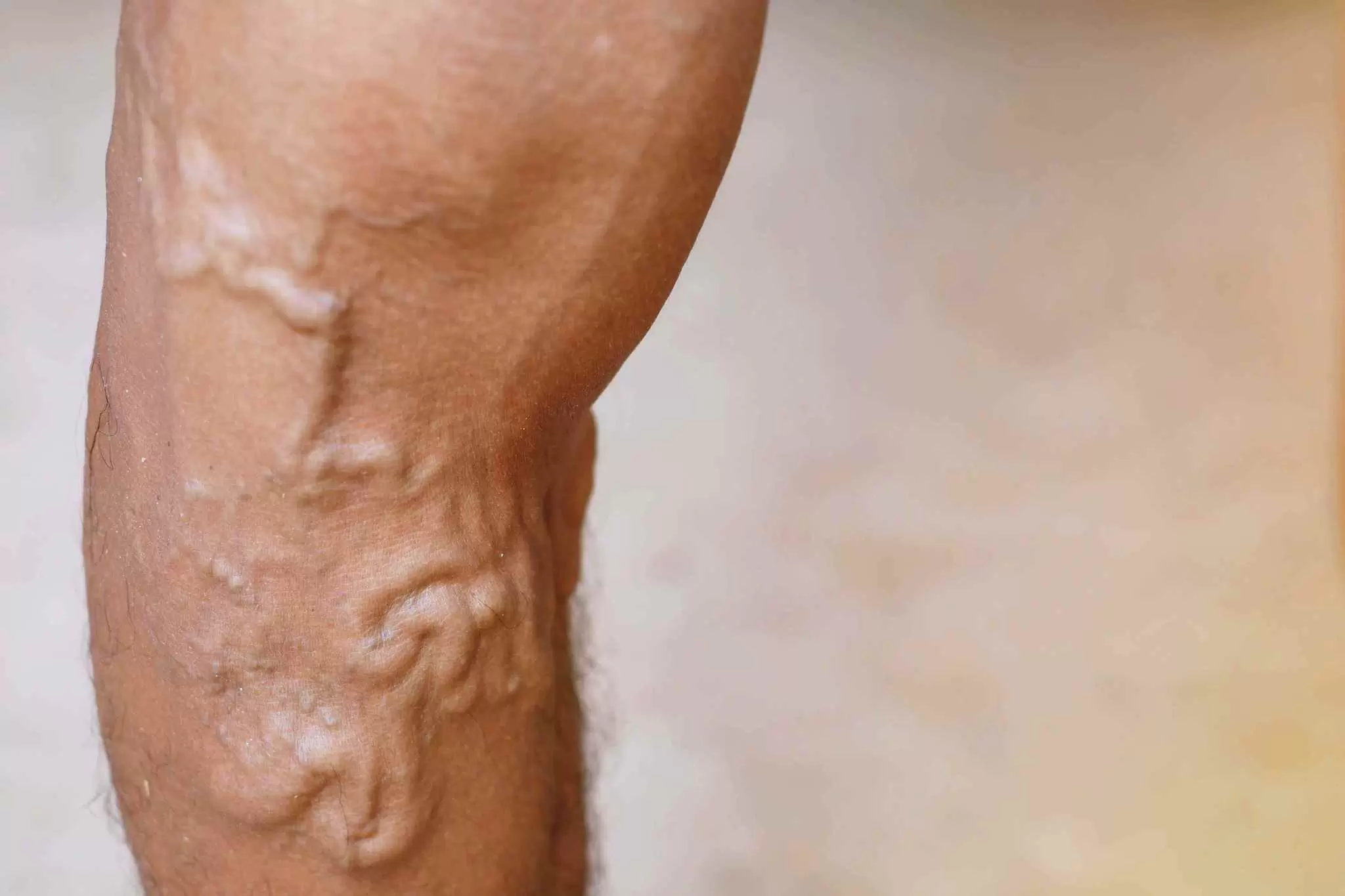 Best Ayurvedic Treatment for Varicose Veins – Causes, Symptoms & Natural Remedies