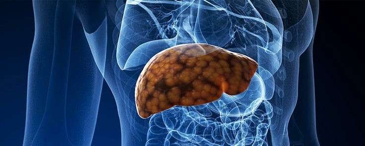 10 Signs That You Have Fatty Liver — Don’t Ignore These Early Warnings!