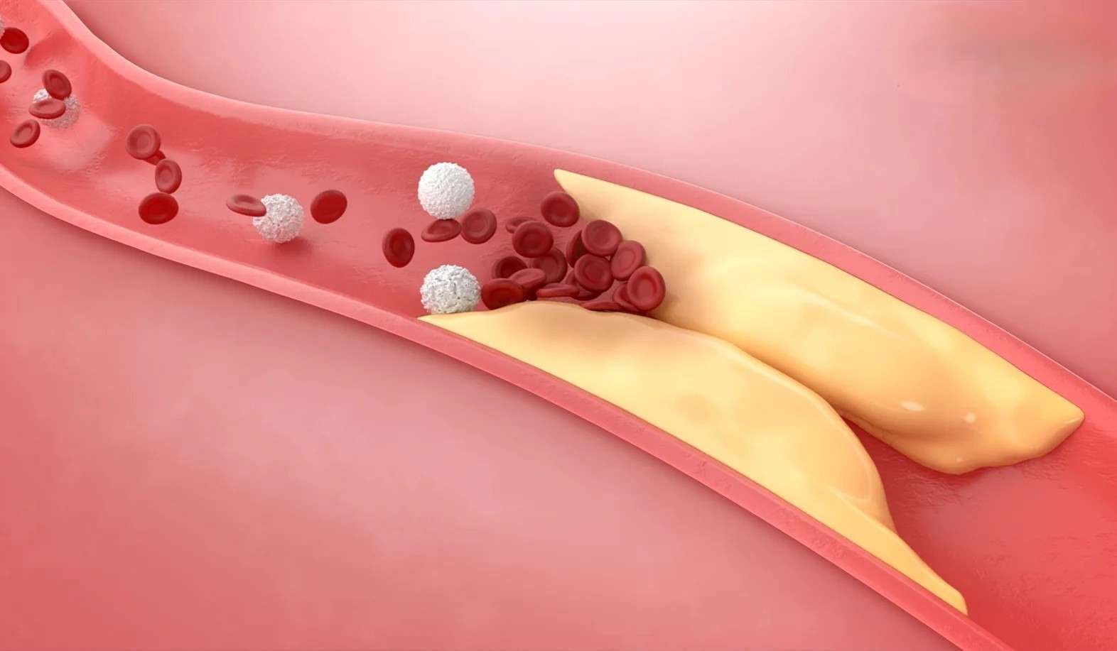 High Cholesterol – Causes, Risks & What You Should Know
