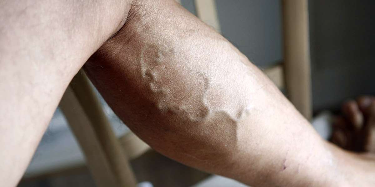 Varicose Veins Treatment in Delhi — Ayurvedic Care, Non-Surgical Options & How Vedic Upchar Helps
