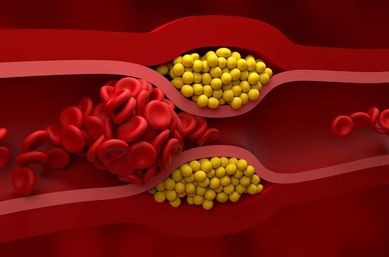 10 Signs That You Have High Cholesterol
