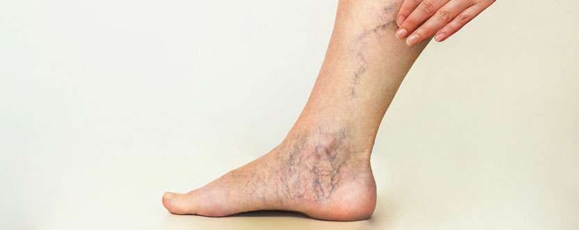 Top 10 Best Varicose Veins Medicine: Natural Relief Backed By Ayurveda