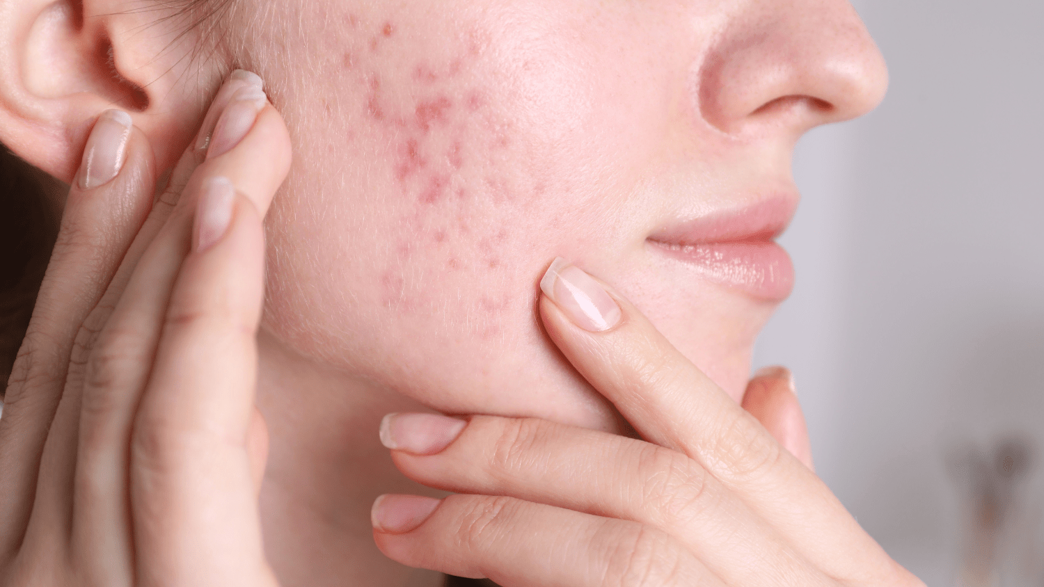 10 Signs That You Have Acne Problem