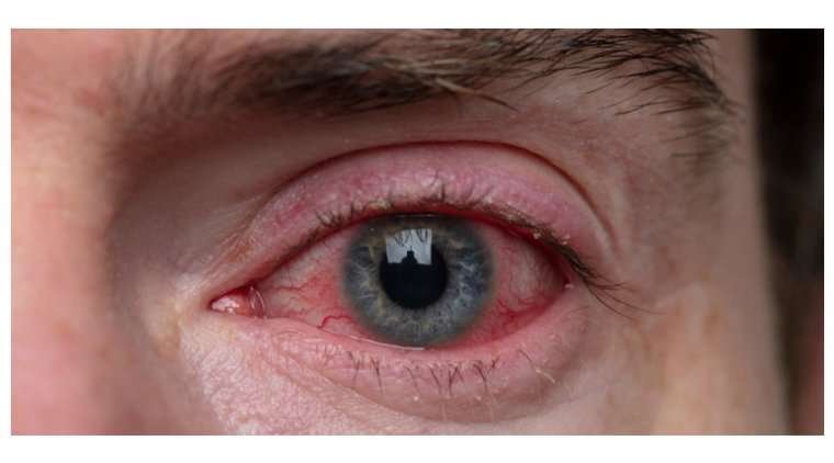 Night Blindness: Causes, Symptoms, and Ayurvedic Remedies