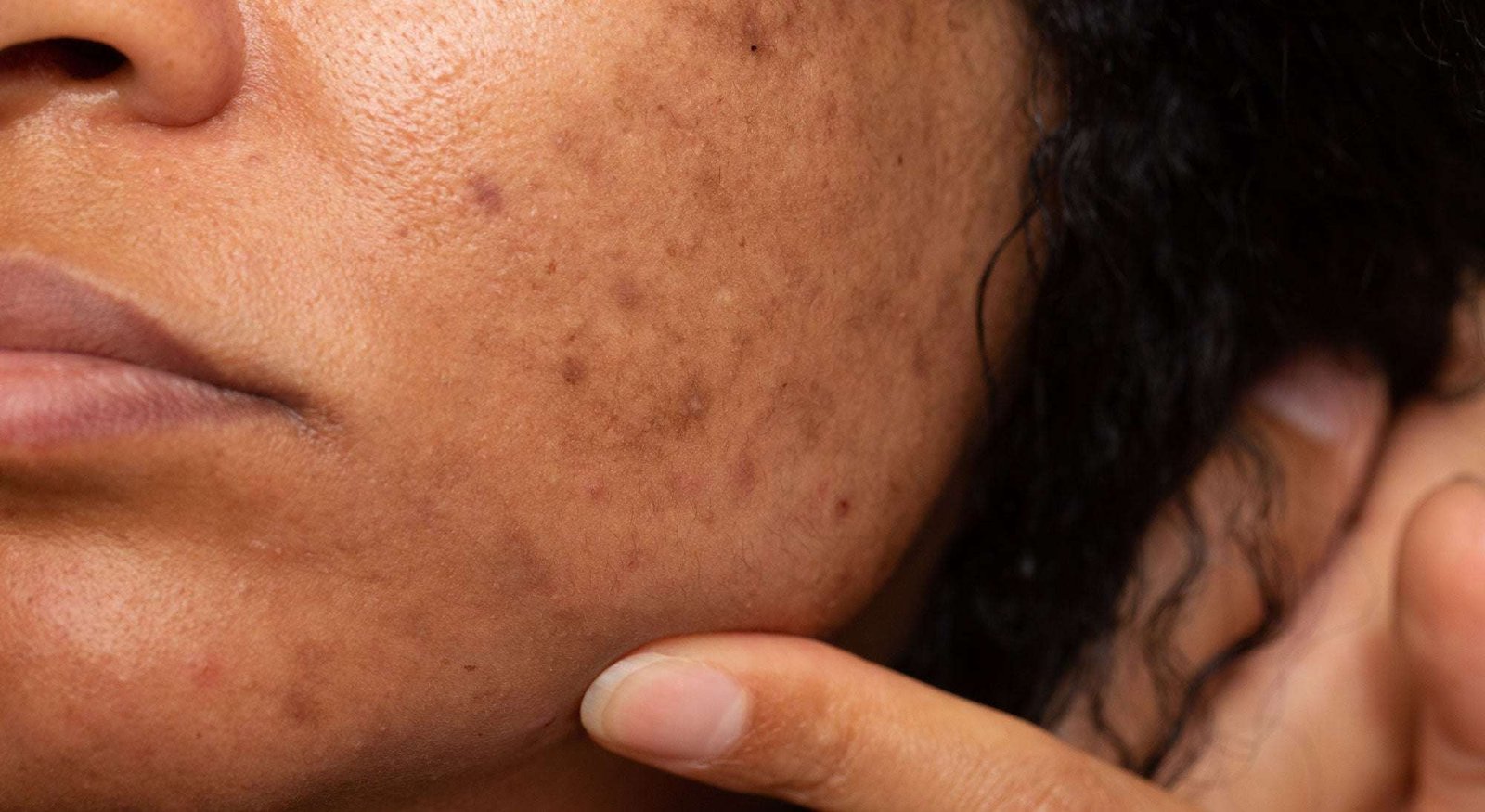10 Signs That You Have Dark Spots Problem