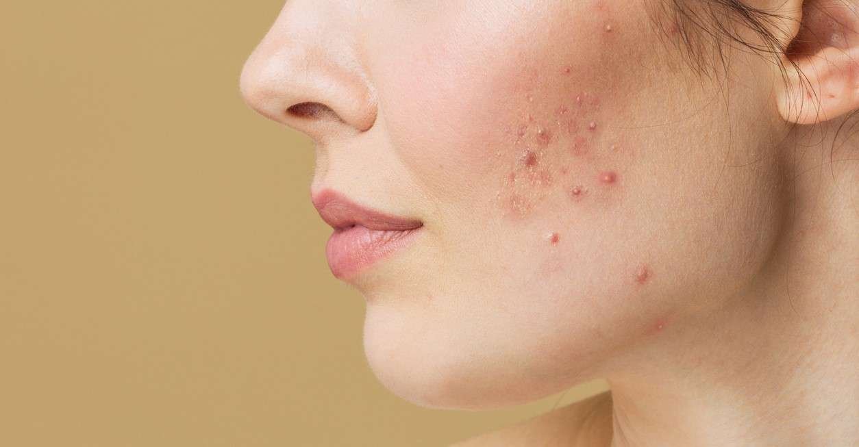 Acne: Causes, Symptoms, and Treatments