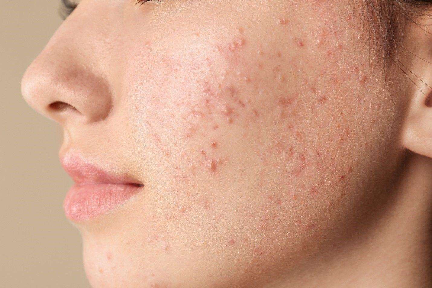 10 Signs That You Have Pimples Problem
