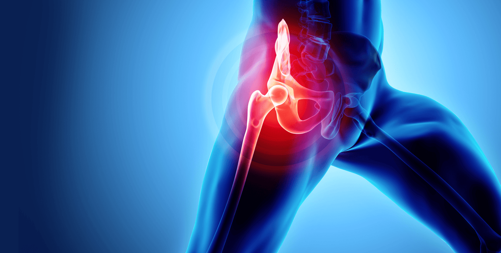 Avascular Necrosis: Causes, Symptoms, and Ayurvedic Care