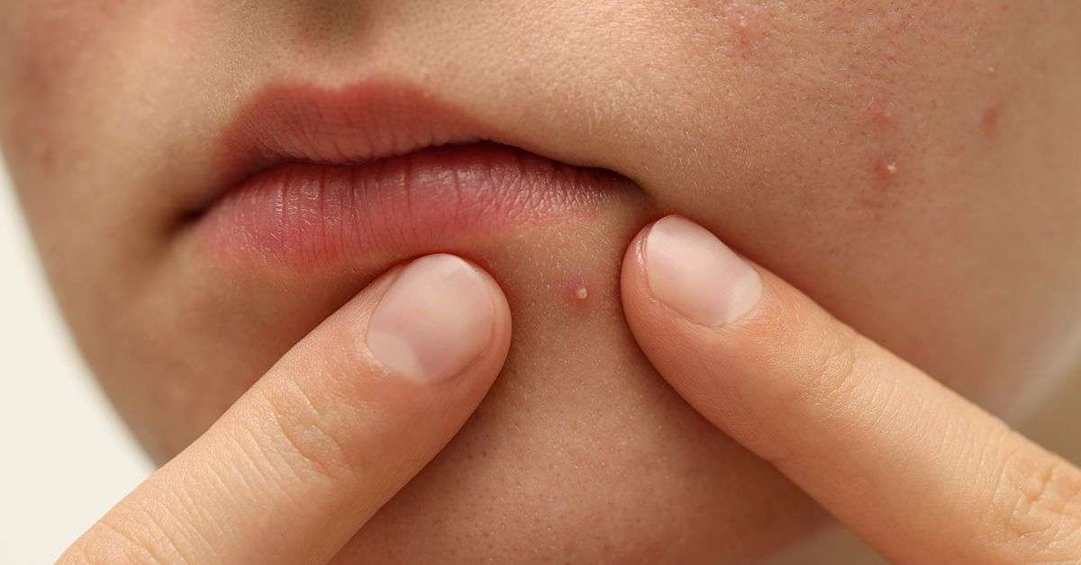 Pimples Problem: Causes, Symptoms, and When to Get Help
