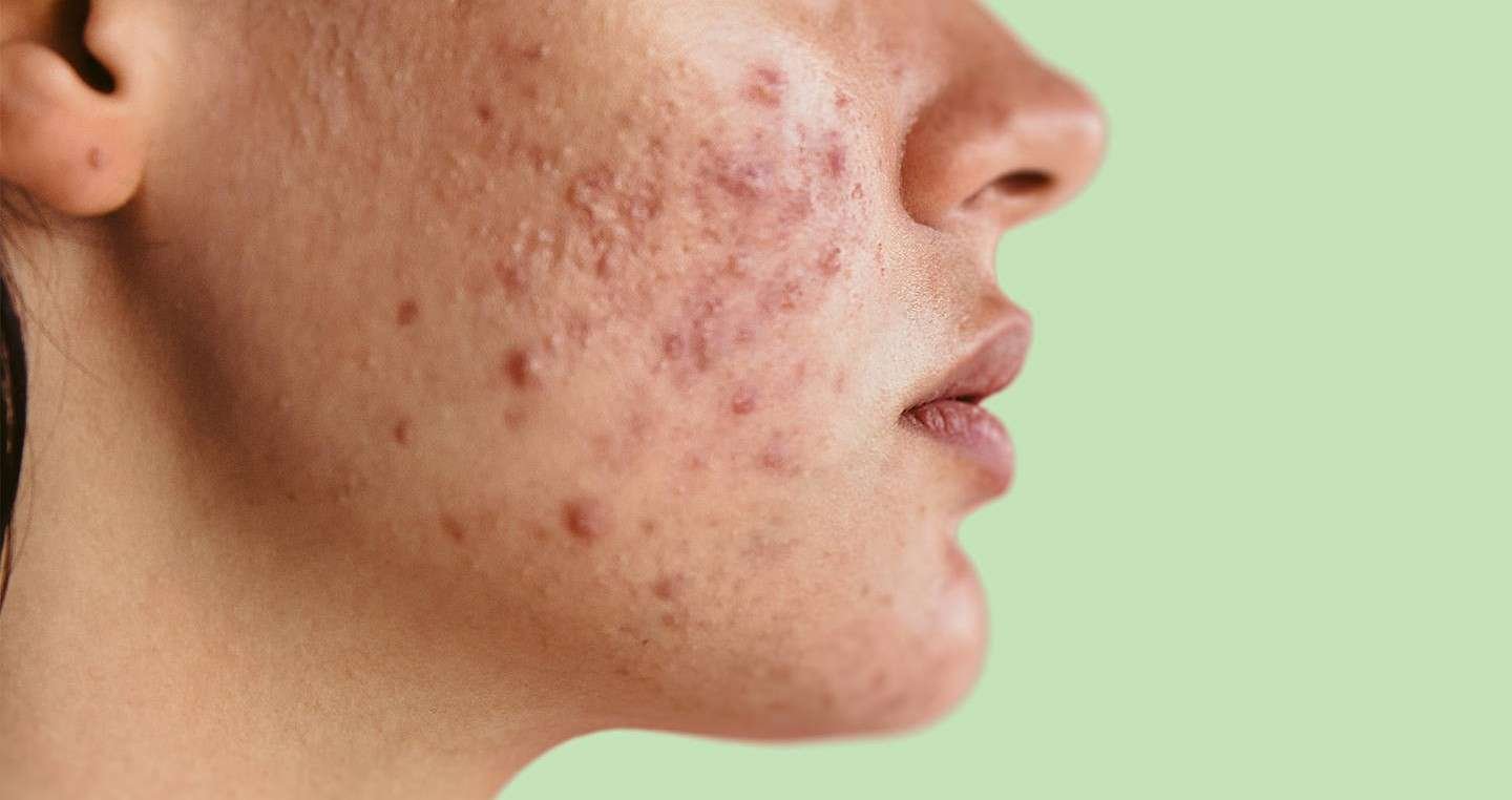 10 Best Remedy for Acne (Ayurvedic & Natural)
