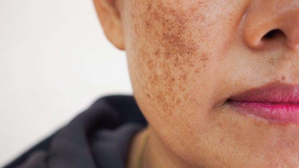 Home remedies for pigmentation — 10 Ayurvedic fixes you can try at home