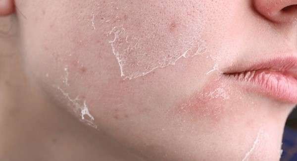 10 Remedies for Dry Skin (Ayurvedic & Natural)