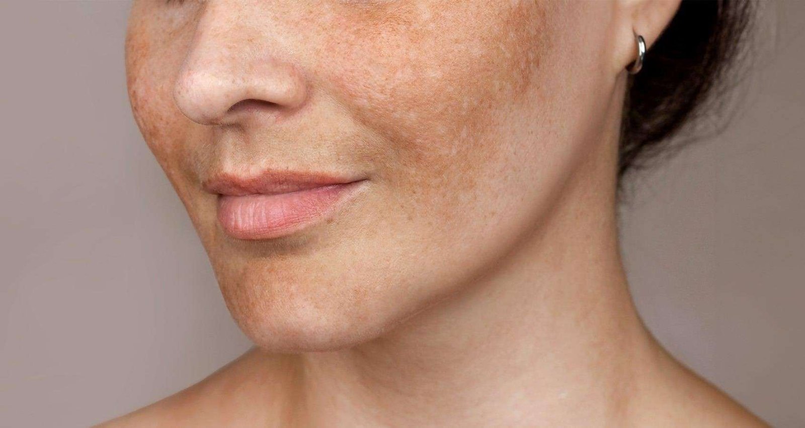 Remedies for Dark Spots: 10 Natural & Ayurvedic Solutions