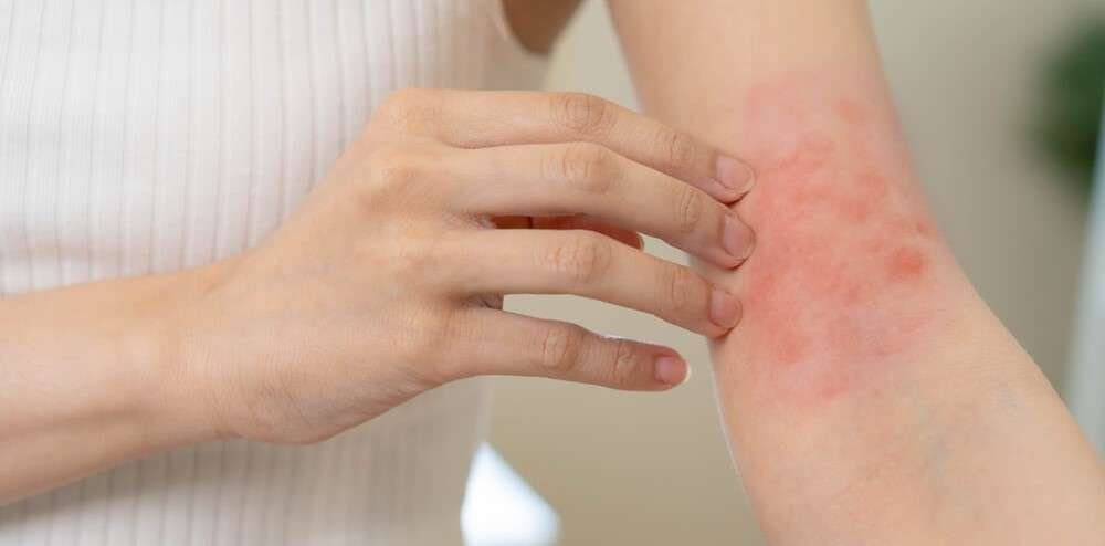 Skin irritation — Causes, Ayurvedic view, and when to get help