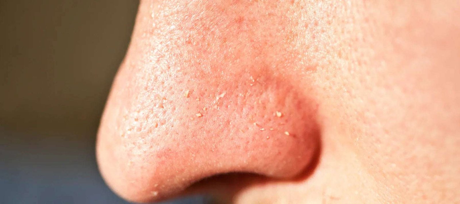 Whiteheads: Ayurvedic Guide to Causes, Care & When to Consult