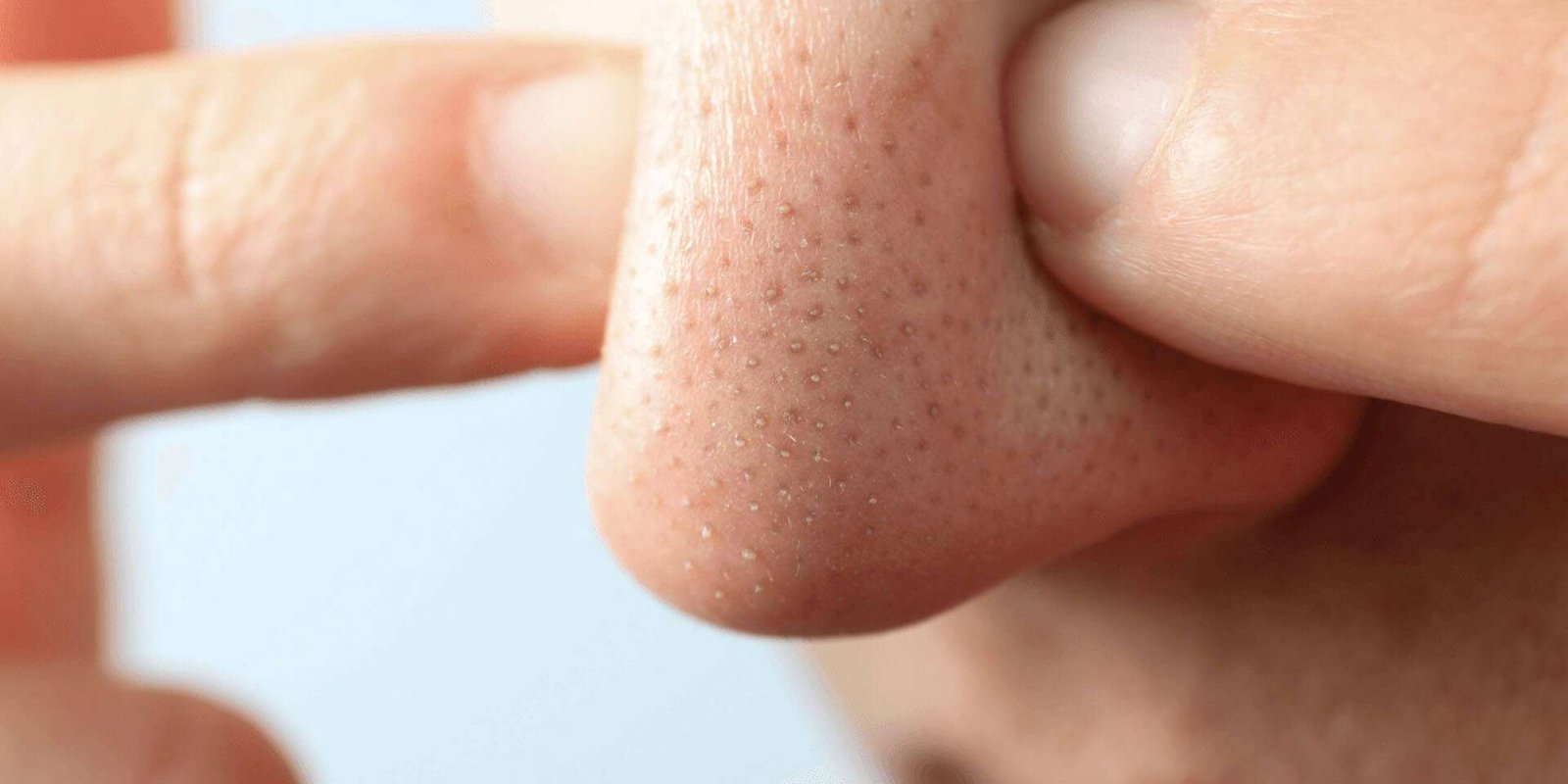 Black Heads: Causes, Care & When to Seek Help