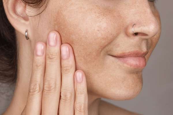 Dark Spots: Causes, Prevention & Ayurvedic Care
