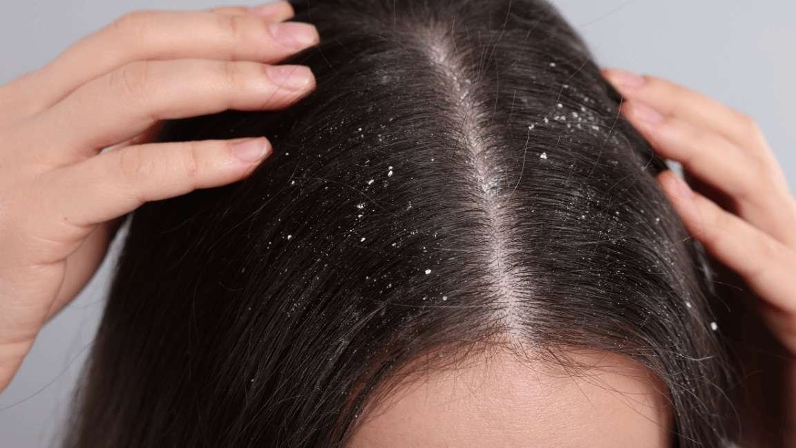How to Treat Dandruff Naturally with Ayurveda
