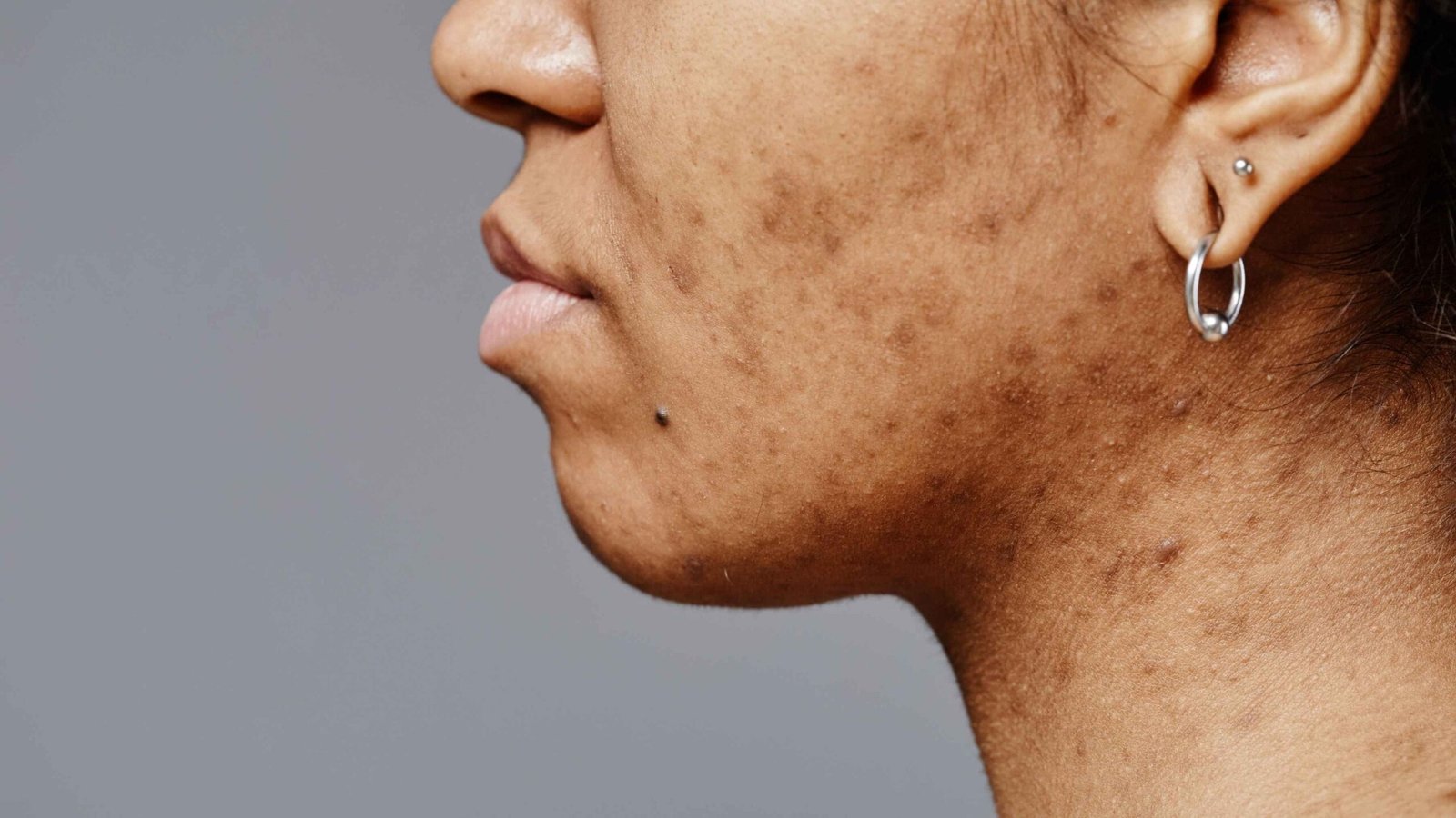 Natural Remedies for Pigmentation and Dark Spots